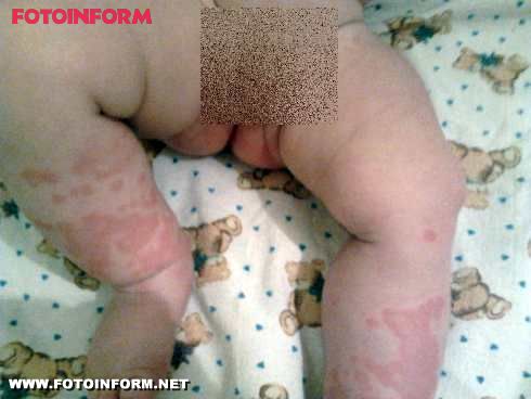 Кировоградские дети пострадали от некачественных памперсов? (фото)